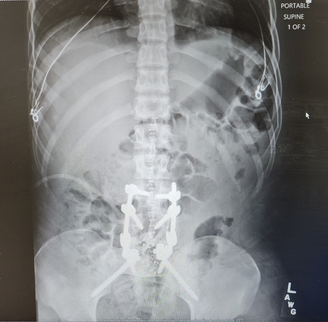 X-ray image shows the extent of surgery required to stabilise Bryce Bourdieu’s spine. Supplied by Julie Farr